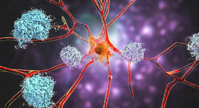 کالبدشکافی مغز مبتلایان به آلزایمر یک عامل احتمالی جدید را برای این بیماری نشان داد
