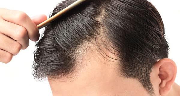 دانشمندان راهی برای توقف ریزش مو پیدا کردند
