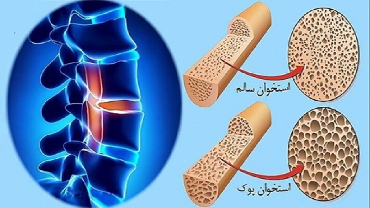 پوکی استخوان، یک بیماری خاموش و مزمن است
