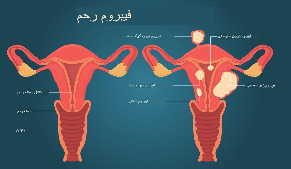 فیبروم رحمی